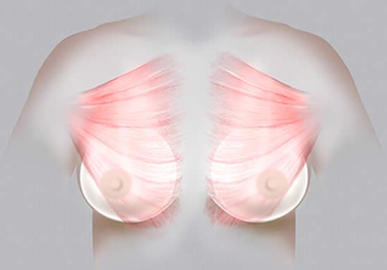 Bröstimplantat placerade submuskulärt
