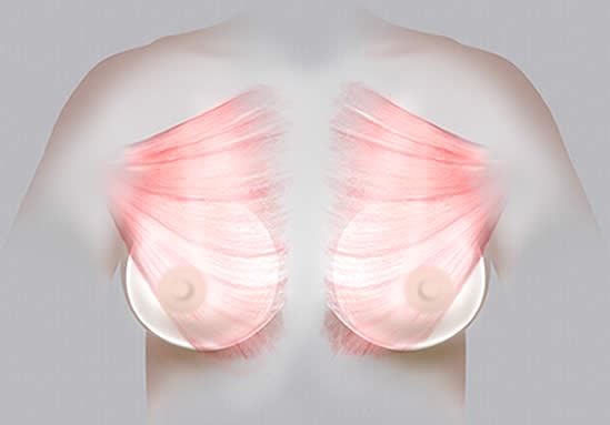 Bröstimplantat placerade submuskulärt