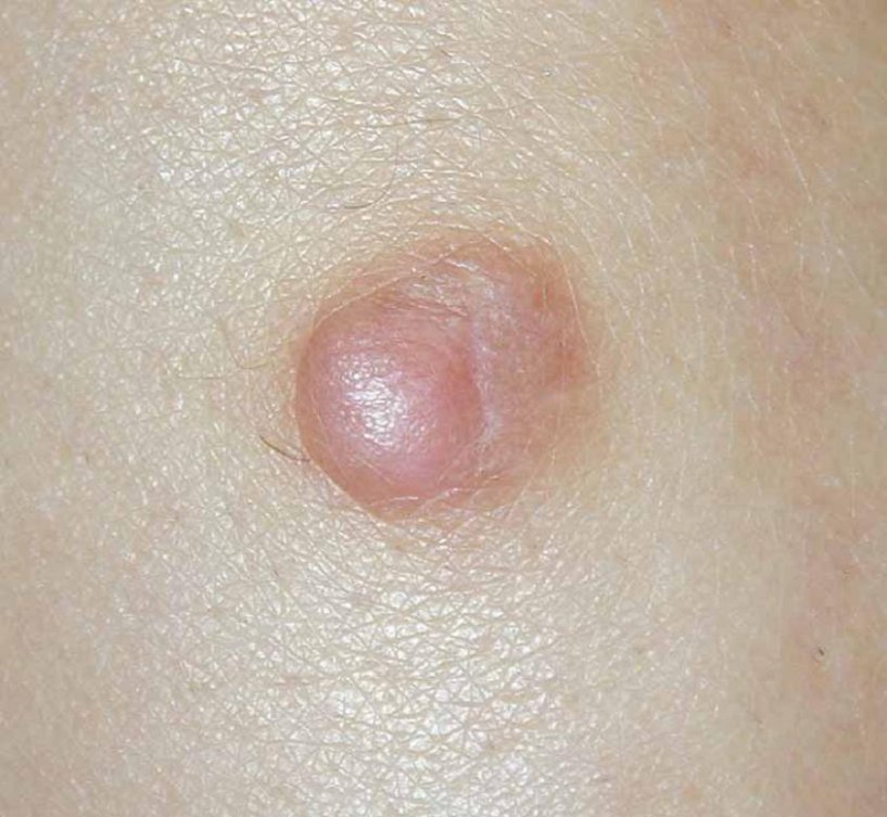 Histiocytom - släta eller upphöjda brunrosa små hudknutor