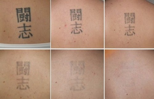 Laserbehandling av en tatuering på ryggen.