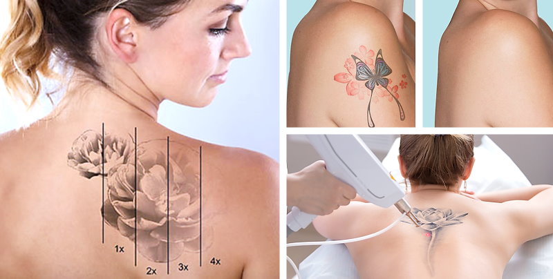 Tatueringsborttagning med laser